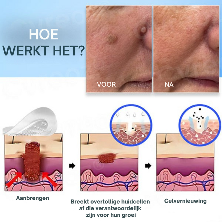 Cvreoz™ Weg Met Steelwratten & Moedervlekken