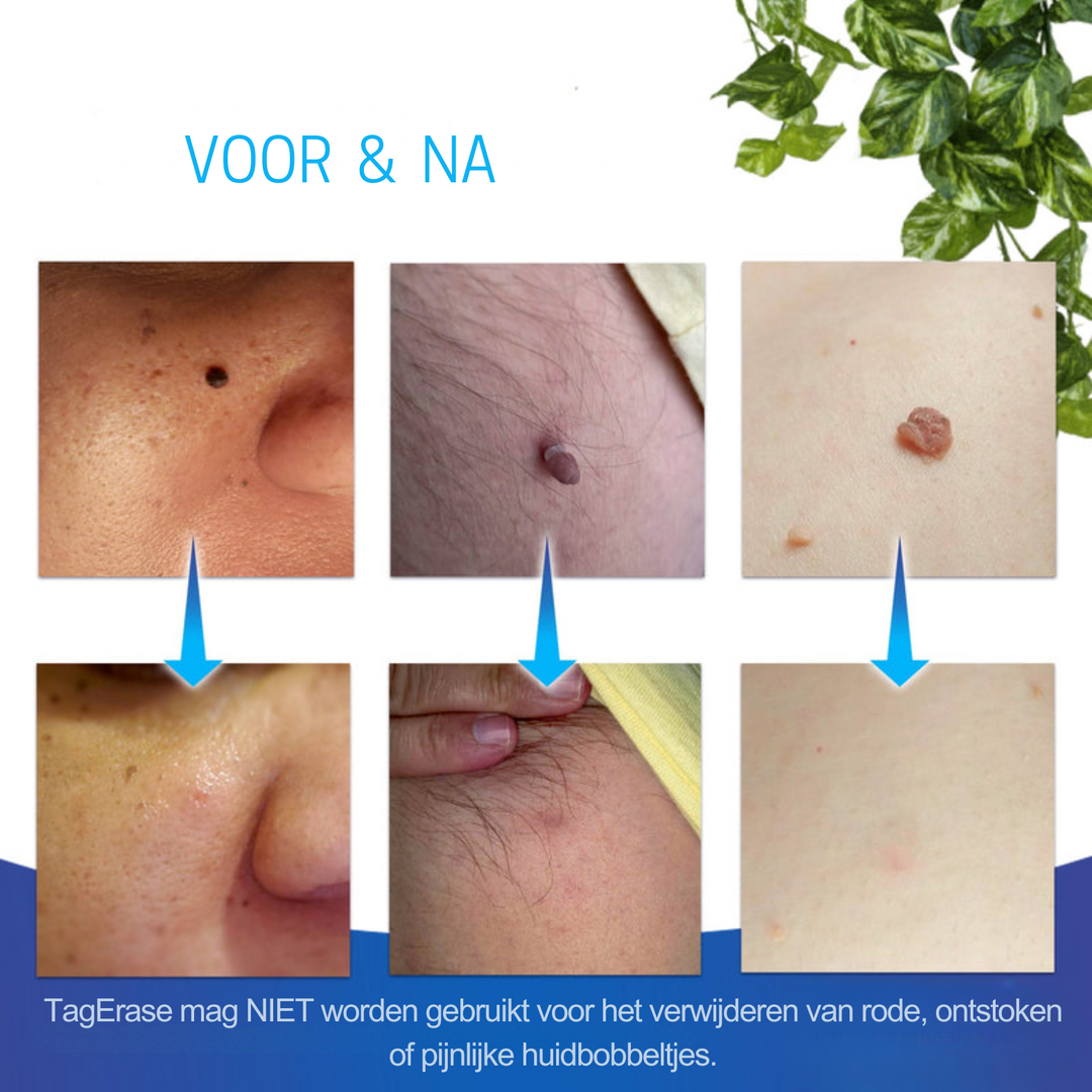 TagErase™ Een Pijnloos Vaarwel Tegen Steelwratten