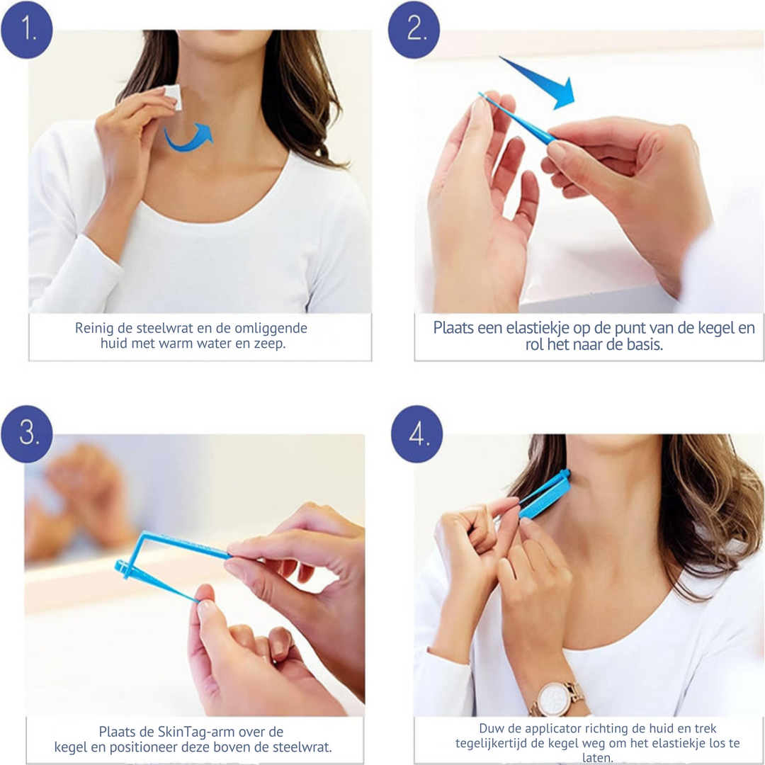 SkinTag™  Verwijder Eenvoudig & Pijnloos Steelwratjes