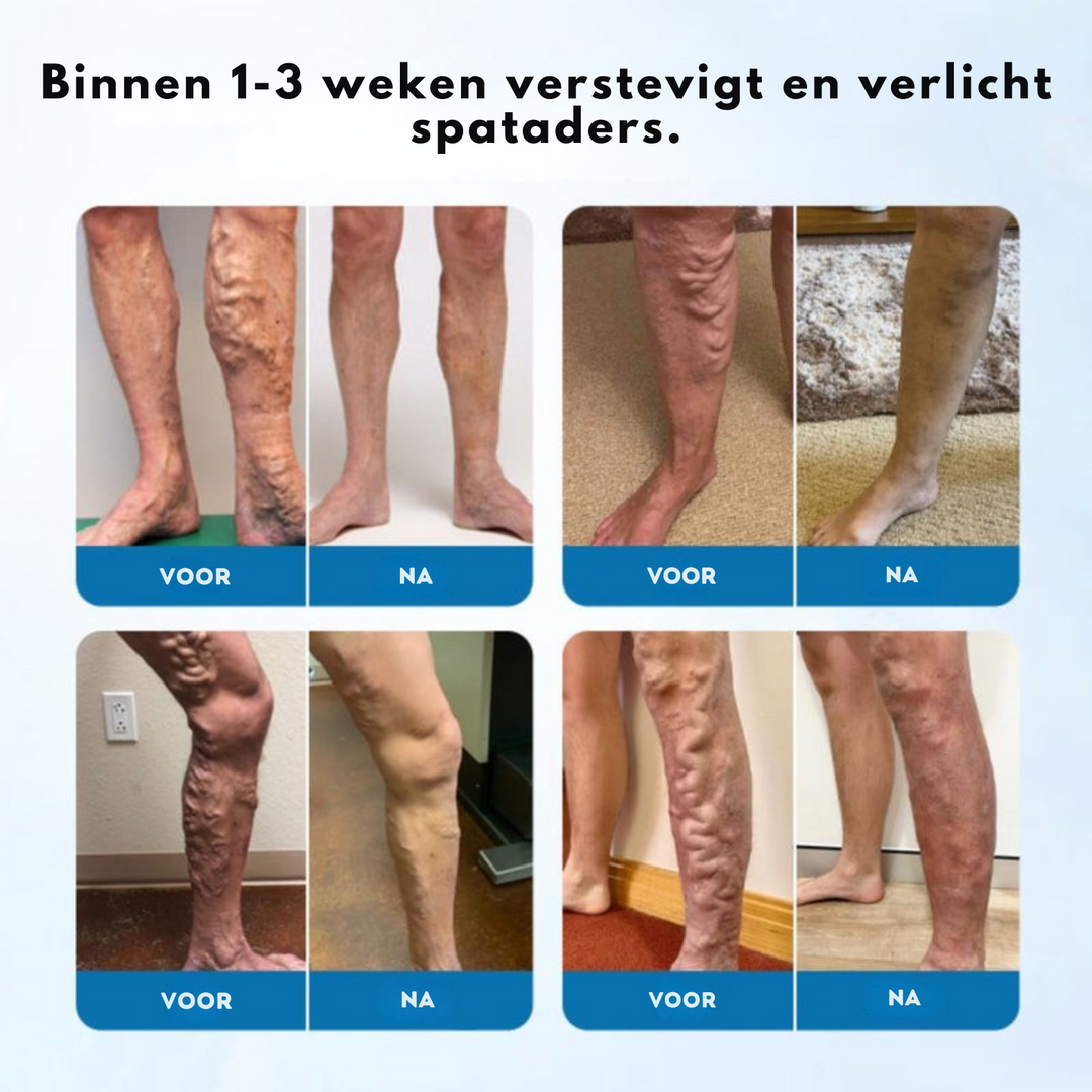 Timilk™ Vaarwel Tegen Spataders