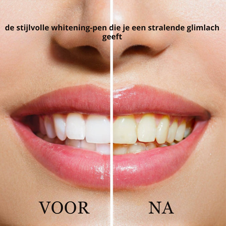 Dentiva™ Direct zichtbaar wittere tanden
