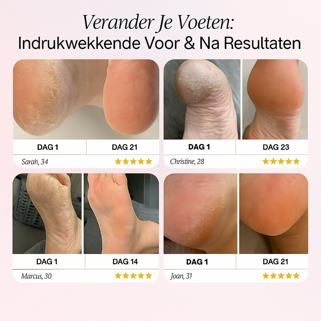 Velvra™  Vaarwel Tegen Eelt