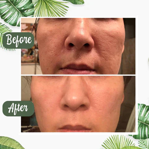 Green Tea Mask™ | Vaarwel Acné & Mee-Eters