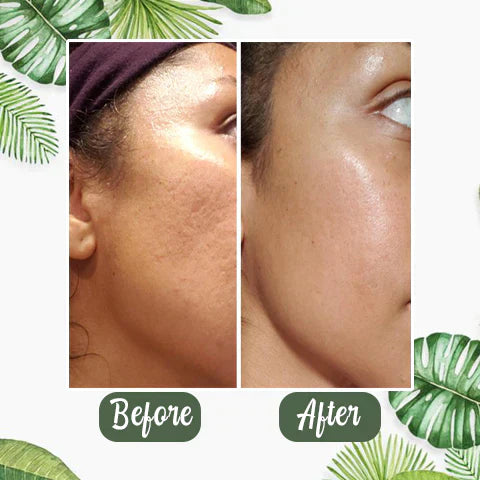 Green Tea Mask™ | Vaarwel Acné & Mee-Eters