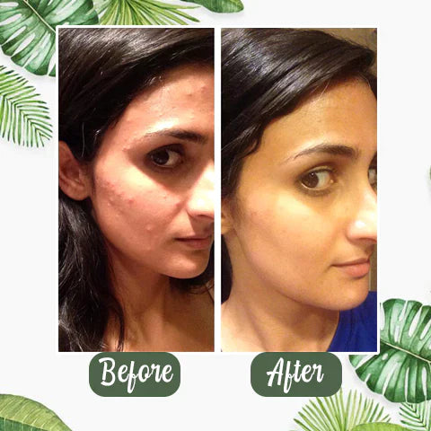 Green Tea Mask™ | Vaarwel Acné & Mee-Eters