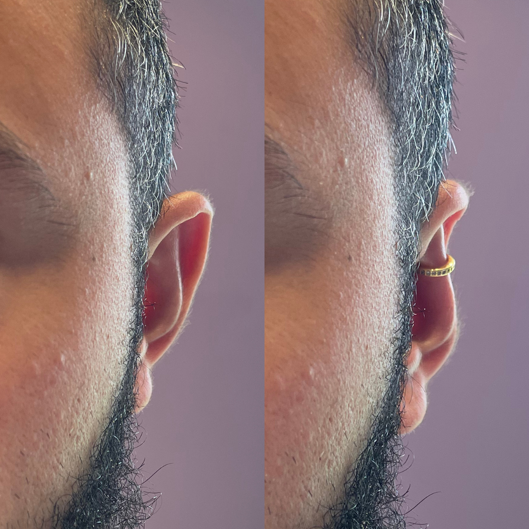 Earvera™ Vaarwel Tegen Flaporen & Terug Zelfverzekerd