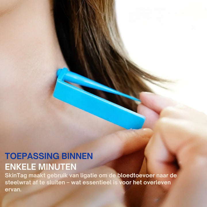 SkinTag™  Verwijder Eenvoudig & Pijnloos Steelwratjes