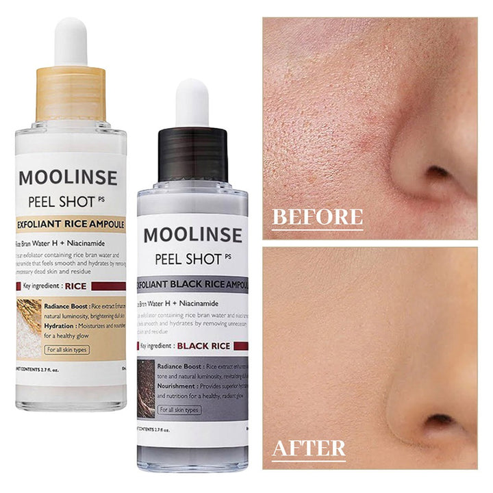 MoolShine™ Vaarwel Tegen Acné & Mee-Eters